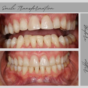 New Town Dentistry - Sure Smile clear orthodontic aligners- A faster more comfortable way to achieve teeth movement Great Results that are designed to last! - General Dentistry Near Me - Waxhaw, North Carolina New Town Dentistry - Sure Smile clear orthodontic aligners- A faster more comfortable way to achieve teeth movement Great Results that are designed to last! - General Dentistry Near Me - Waxhaw, North Carolina