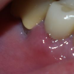 Weston Dental Group - The gum is swollen because it's being pinched by the oversize abutment.