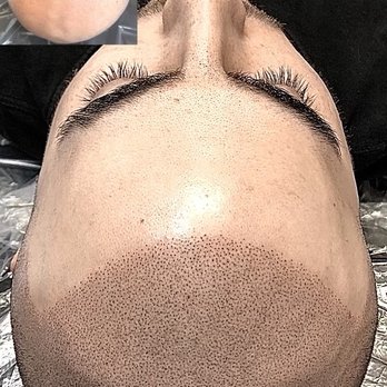 Full Micropigmentation - Hair Loss Centers Near Me - Las Vegas, Nevada Full Micropigmentation - Hair Loss Centers Near Me - Las Vegas, Nevada