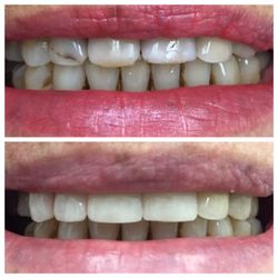 Deerfield Family Dental - Before and after veneers