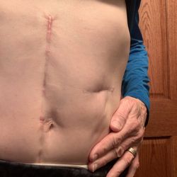 Nura Pain Clinics - The scar after it had to be treated from opening me up so many times