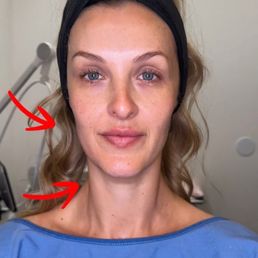 Halfway through the treatment: slight lift and snatching of my cheekbone/jawline treated area Halfway through the treatment: slight lift and snatching of my cheekbone/jawline treated area