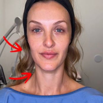 17 MedSpa - Halfway through the treatment: slight lift and snatching of my cheekbone/jawline treated area - Medical Spas Near Me - Buena Park, California 17 MedSpa - Halfway through the treatment: slight lift and snatching of my cheekbone/jawline treated area - Medical Spas Near Me - Buena Park, California