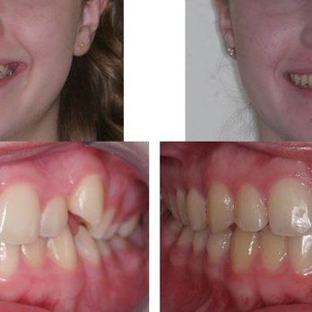 Pair Orthodontics - Your new smile is fantastic, Hailey! - Orthodontists Near Me - Calabasas, California Pair Orthodontics - Your new smile is fantastic, Hailey! - Orthodontists Near Me - Calabasas, California
