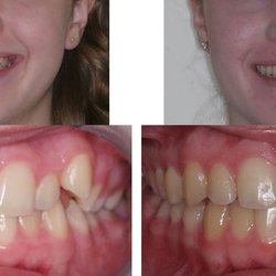 Pair Orthodontics - Your new smile is fantastic, Hailey!