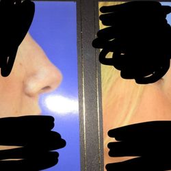 DeRosa Center Plastic Surgery and Med Spa - Photo on left is POST botched Jamie Derosa rhinoplasty. Photo on right is post my revision rhinoplasty with other surgeon