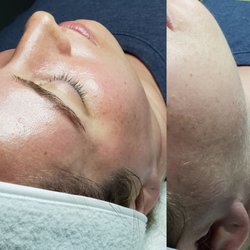 Skin Identity - Before & After ::. Signature Detox with Dermaplane Facial