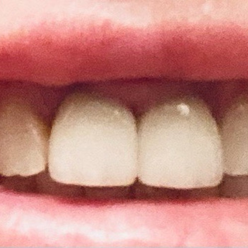 Ronald Lo, DDS - My crowns after replacement. - General Dentistry Near Me - Tacoma, Washington Ronald Lo, DDS - My crowns after replacement. - General Dentistry Near Me - Tacoma, Washington