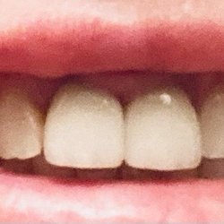 Ronald Lo, DDS - My crowns after replacement.