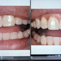 Before and after bonding on my two front teeth.