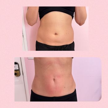Sassy Med Spa - 2 sessions of Lemon Bottle and 4 sessions of body contouring - Medical Spas Near Me - Sherman Oaks, California Sassy Med Spa - 2 sessions of Lemon Bottle and 4 sessions of body contouring - Medical Spas Near Me - Sherman Oaks, California