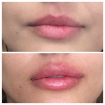 Glo Medspa - Lip injections with 1 syringe of Restylane Defyne - Medical Spas Near Me - Scottsdale, Arizona Glo Medspa - Lip injections with 1 syringe of Restylane Defyne - Medical Spas Near Me - Scottsdale, Arizona