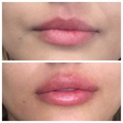 Glo Medspa - Lip injections with 1 syringe of Restylane Defyne