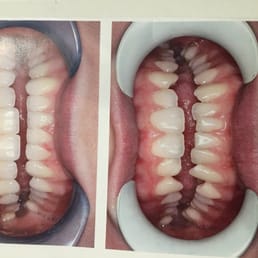Befor and after veneers. Top 8. Bottom 8. Befor and after veneers. Top 8. Bottom 8.