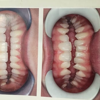Karen Arakelian DDS - Befor and after veneers. Top 8. Bottom 8. - General Dentistry Near Me - Sherman Oaks, California Karen Arakelian DDS - Befor and after veneers. Top 8. Bottom 8. - General Dentistry Near Me - Sherman Oaks, California