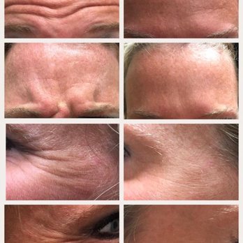 Elysian Med Spa - Amazing before and after of a client who received Dysport! - Medical Spas Near Me - London, Kentucky Elysian Med Spa - Amazing before and after of a client who received Dysport! - Medical Spas Near Me - London, Kentucky