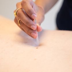 Orleans Physiotherapy - Acupuncture & Dry Needling