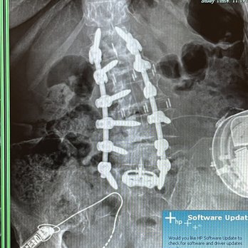 Rasouli Spine - My spine after surgery - Spine Surgeons Near Me - Beverly Hills, California