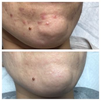 Hello Beautiful Skin & Acne Studio - Skin Care Near Me - Redondo Beach, California