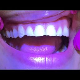 My teeth before bravo dental My teeth before bravo dental