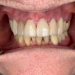 SmileMakers - Teeth after new crowns