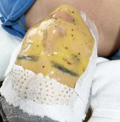 Jelly Mask Treatments (Hydra-Facial) - $20 Off 1st Time Hydra-facial Clients. Licensed aesthetician with 5+ years of experience providing affordable & thorough skin care treatments for all skin types. I specialize in hydra-facials, anti-aging facials, microdermabrasion facials, nano-needling treatments, & customizable acne facials. Facials can include ultrasonic scrubbing, hydro-dermabrasion, UV light therapy, & eye rejuvenation. I work with each client to provide a bespoke treatment experience to best treat their skincare needs. We specialize in body contouring cavitation as well. Call today to claim your $20 Off New Client Discount for Hydra-Facials!