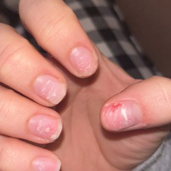 Aqua Nails Pedi Spa - Burned nail beds from bond - Nail Salons Near Me - Angleton, Texas