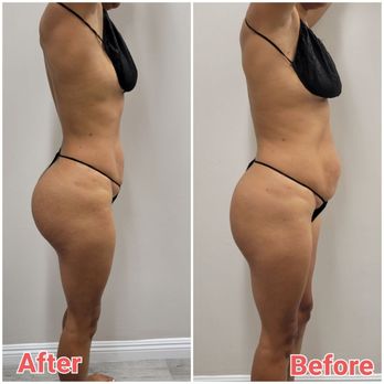 Skin Envy CO - Cavitation with RF and EMS combo - Cryotherapy Near Me - Redlands, California Skin Envy CO - Cavitation with RF and EMS combo - Cryotherapy Near Me - Redlands, California