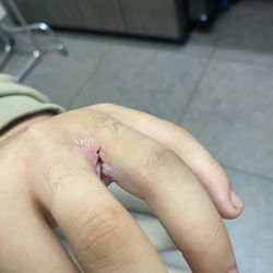 CityMD Crown Heights Urgent Care - Brooklyn - The cut that they glue up with skin glue