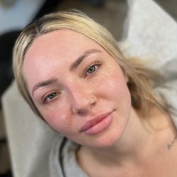 BeautyCamo - Healed freckles