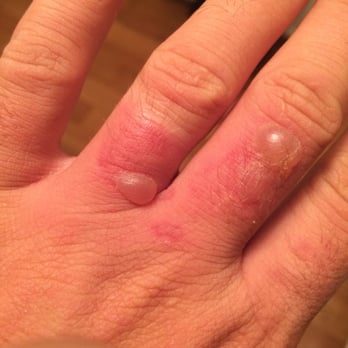 Famous Toastery - Outside coffee station java was spilled on my hand resulting in 2nd degree burns. Still waiting call back from owners. - Breakfast & Brunch Near Me - Davidson, North Carolina Famous Toastery - Outside coffee station java was spilled on my hand resulting in 2nd degree burns. Still waiting call back from owners. - Breakfast & Brunch Near Me - Davidson, North Carolina