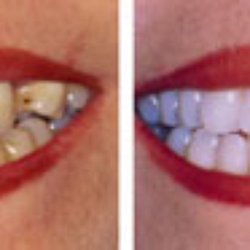 Premier Esthetics Dental Office of Mark R. Gadberry D.D.S. - Premier Esthetics specializes in cosmetic dentistry: Teeth Whitening