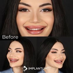 Implantum Dental Clinic - Ceramics embody high aesthetics, reliability, and stability, bringing joy for many years to come.