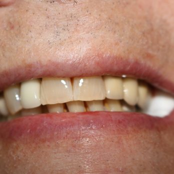 Main Street Dental - Appointment #2-bridge cemented in. You can chew, talk, eat like normal! - Pediatric Dentists Near Me - Gresham, Oregon Main Street Dental - Appointment #2-bridge cemented in. You can chew, talk, eat like normal! - Pediatric Dentists Near Me - Gresham, Oregon