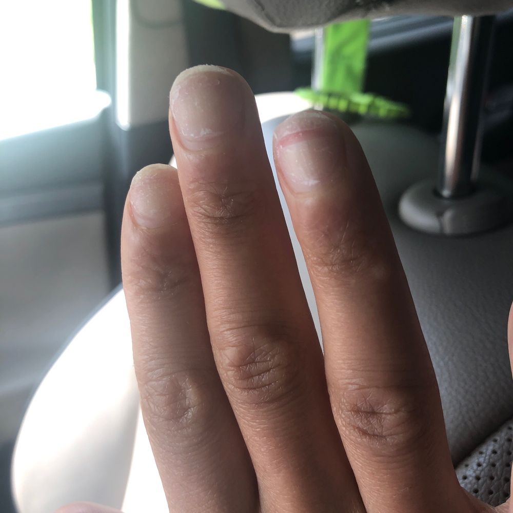 Layer of my nail ripped from my acrylic being ripped off as opposed to soaked off. Layer of my nail ripped from my acrylic being ripped off as opposed to soaked off.