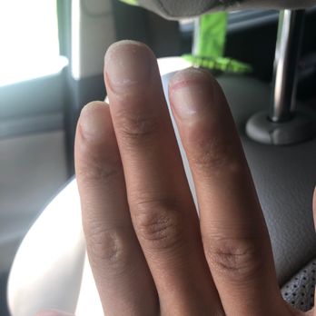 Luxury Nail Spa - Layer of my nail ripped from my acrylic being ripped off as opposed to soaked off. - Nail Salons Near Me - Oak Park, Illinois Luxury Nail Spa - Layer of my nail ripped from my acrylic being ripped off as opposed to soaked off. - Nail Salons Near Me - Oak Park, Illinois