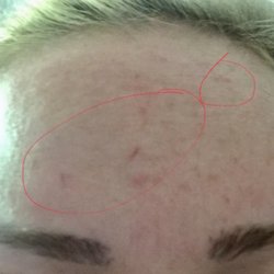 Sacramento Surgical Arts - Scratch like marks appeared day after botox injections from this location. The doctor put all 30 units in the center of my forehead