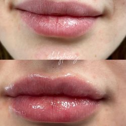 BabyFace Scottsdale Med Spa - Versa lip filler in Scottsdale creates beautifully sexy lips!