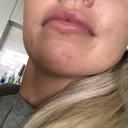 Christos Doctors Inn Walk In Healthcare - There was a deep big pimple yesterday and this morning completely flat and hardly any redness, you can see where the two spots were