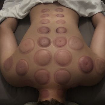 My Massage Kneads - Cupping therapy - Massage Therapy Near Me