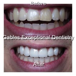 Gables Exceptional Dentistry - Veneers just like the patient wanted