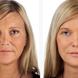 Ageless U Med Spa - Laser resurfacing