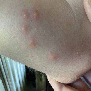 Sun Outdoors Rehoboth Bay - Bed bug bites from the resort - Campgrounds Near Me - Millsboro, Delaware Sun Outdoors Rehoboth Bay - Bed bug bites from the resort - Campgrounds Near Me - Millsboro, Delaware