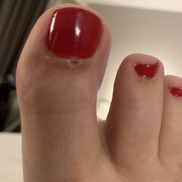 Bleeding on front of toe. Bleeding on front of toe.