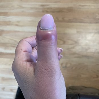 Classic Nails - Infected finger after getting nails dine here. - Nail Salons Near Me - Atlanta, Georgia