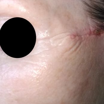 The Lucas Center - crows feet created by incision - Cosmetic Surgeons Near Me - Knoxville, Tennessee The Lucas Center - crows feet created by incision - Cosmetic Surgeons Near Me - Knoxville, Tennessee