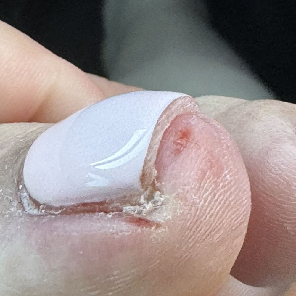 Big toe with cuts