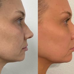 Before and After photos, 3 weeks apart. I had the PRP under the eye and lip filler.