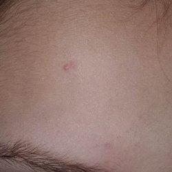 Re/Max Cove Mountain Realty & Cabin Rentals - BED BUG BITES