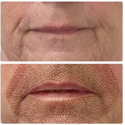 Lip flip and smoker line removal